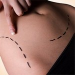 Липосакция живота цены Липосакция живота цены