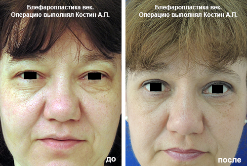Блефаропластика Блефаропластика