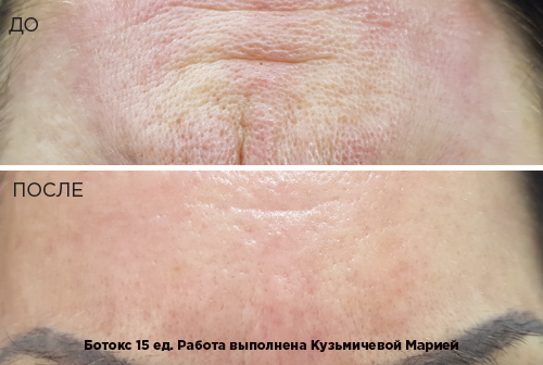  ( Botox  15 .)